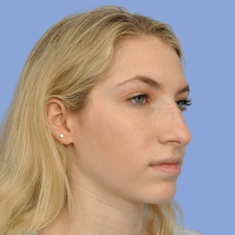 Rhinoplasty Before & After