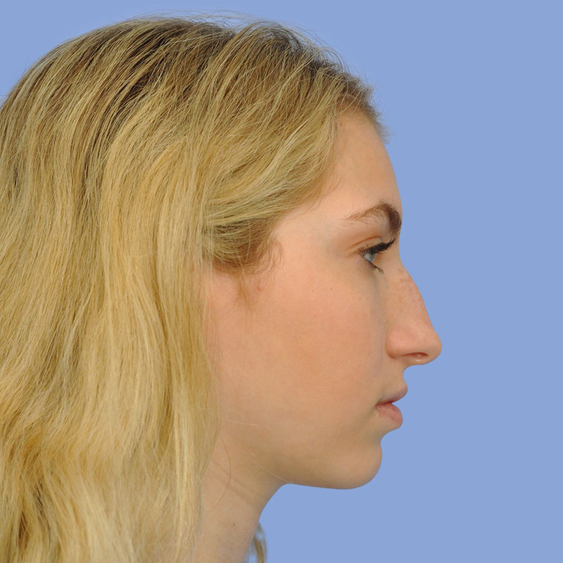 Rhinoplasty Before & After