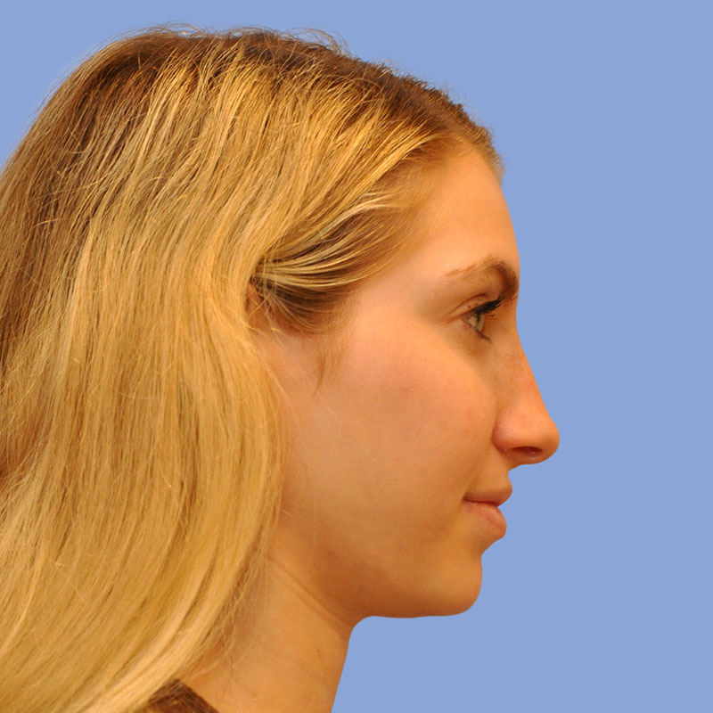 Rhinoplasty Before & After